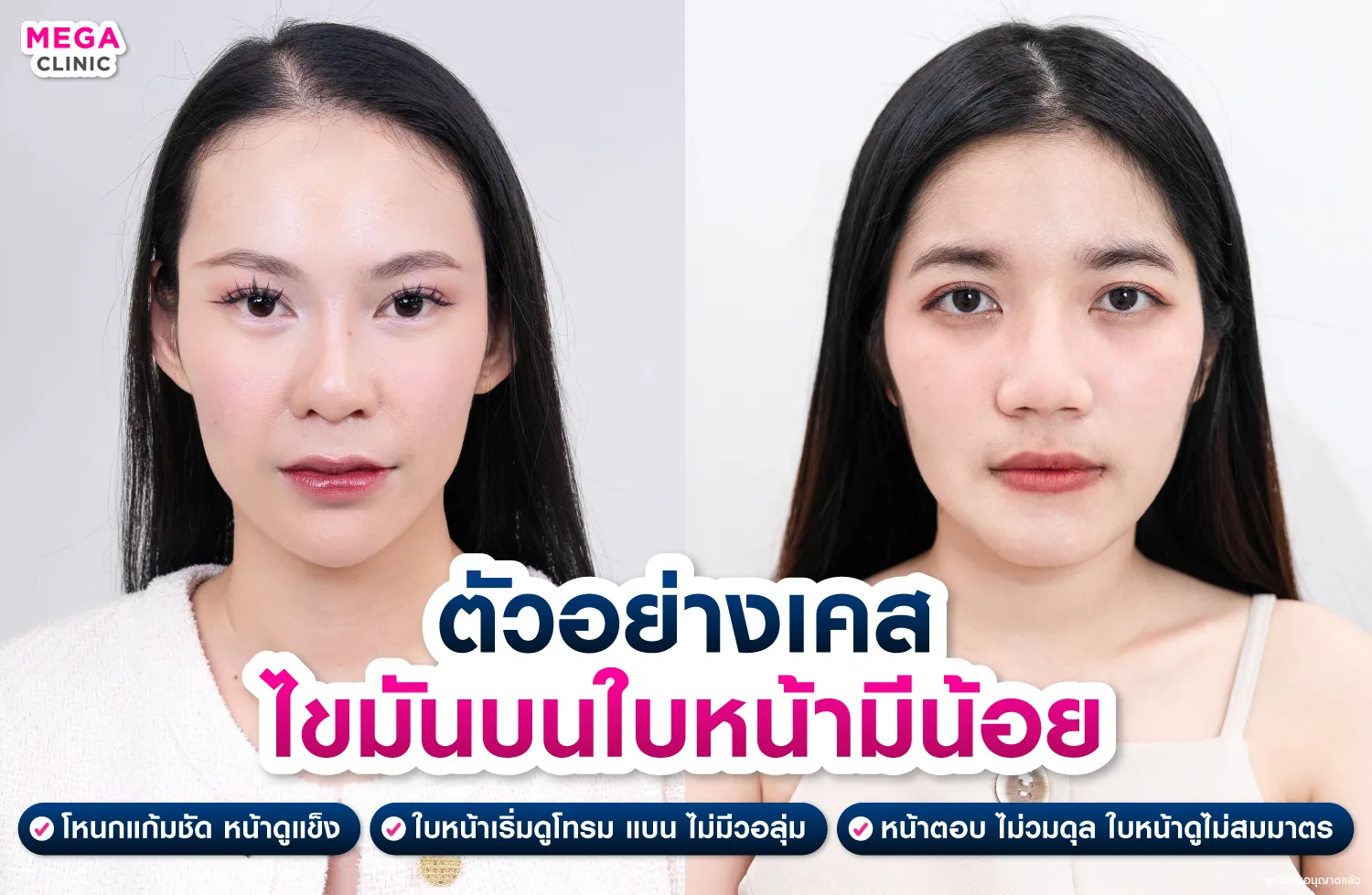 คนที่ไขมันบนใบหน้าและเบบี้แฟตเริ่มหาย