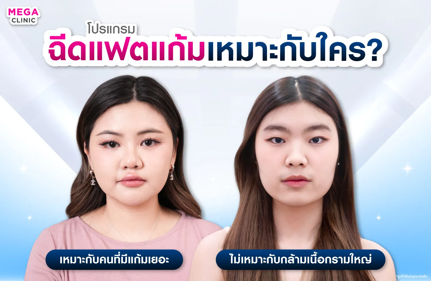 ฉีดแฟตแก้มเหมาะกับใคร