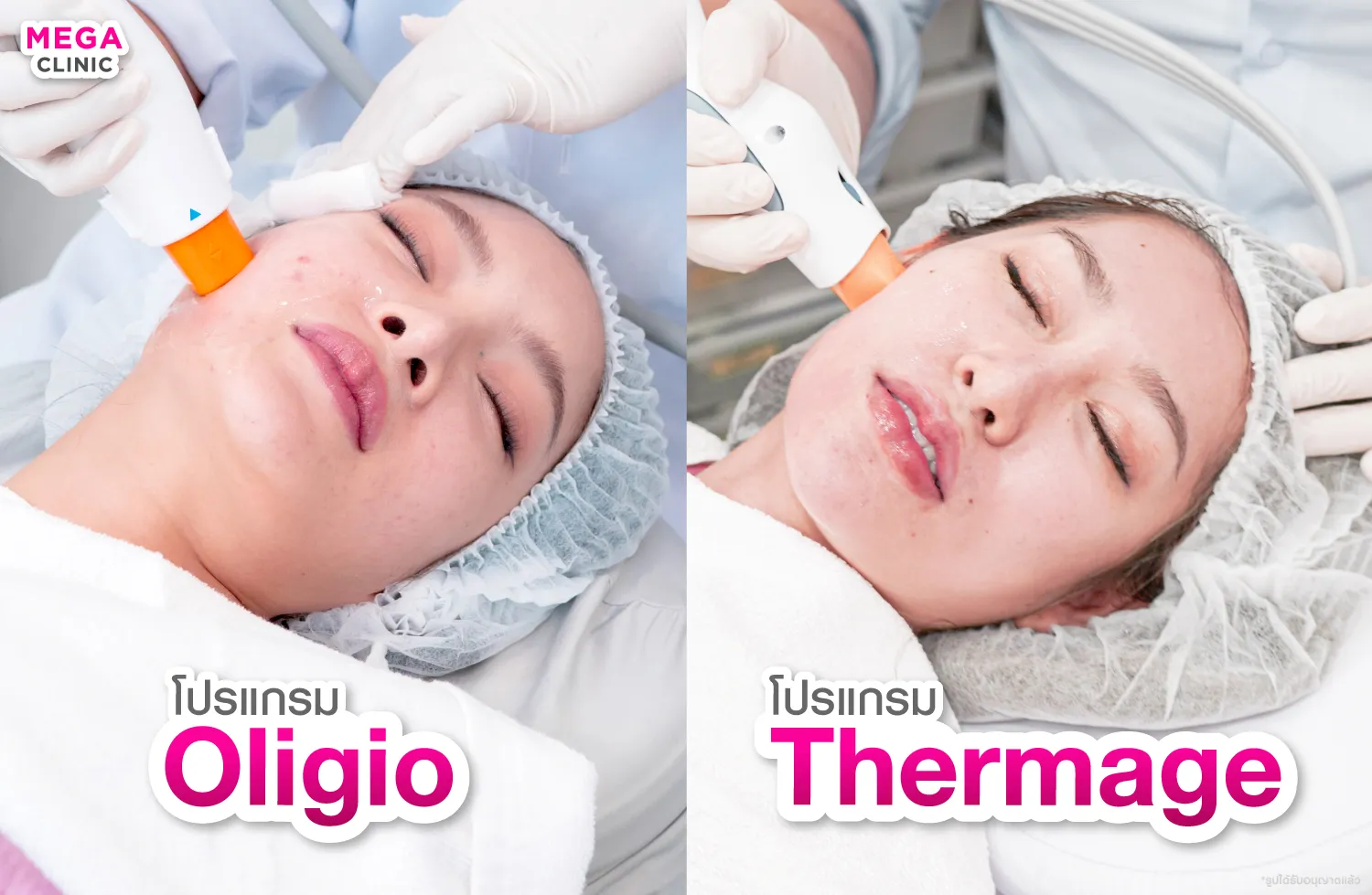 Oligio และ Thermage ช่วยสลายไขมันแก้ม และเหนียง
