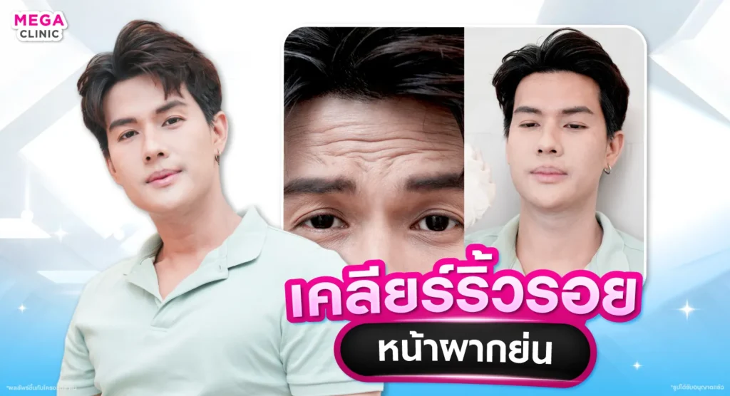 โบท็อกหน้าผาก แก้หน้าผากย่น