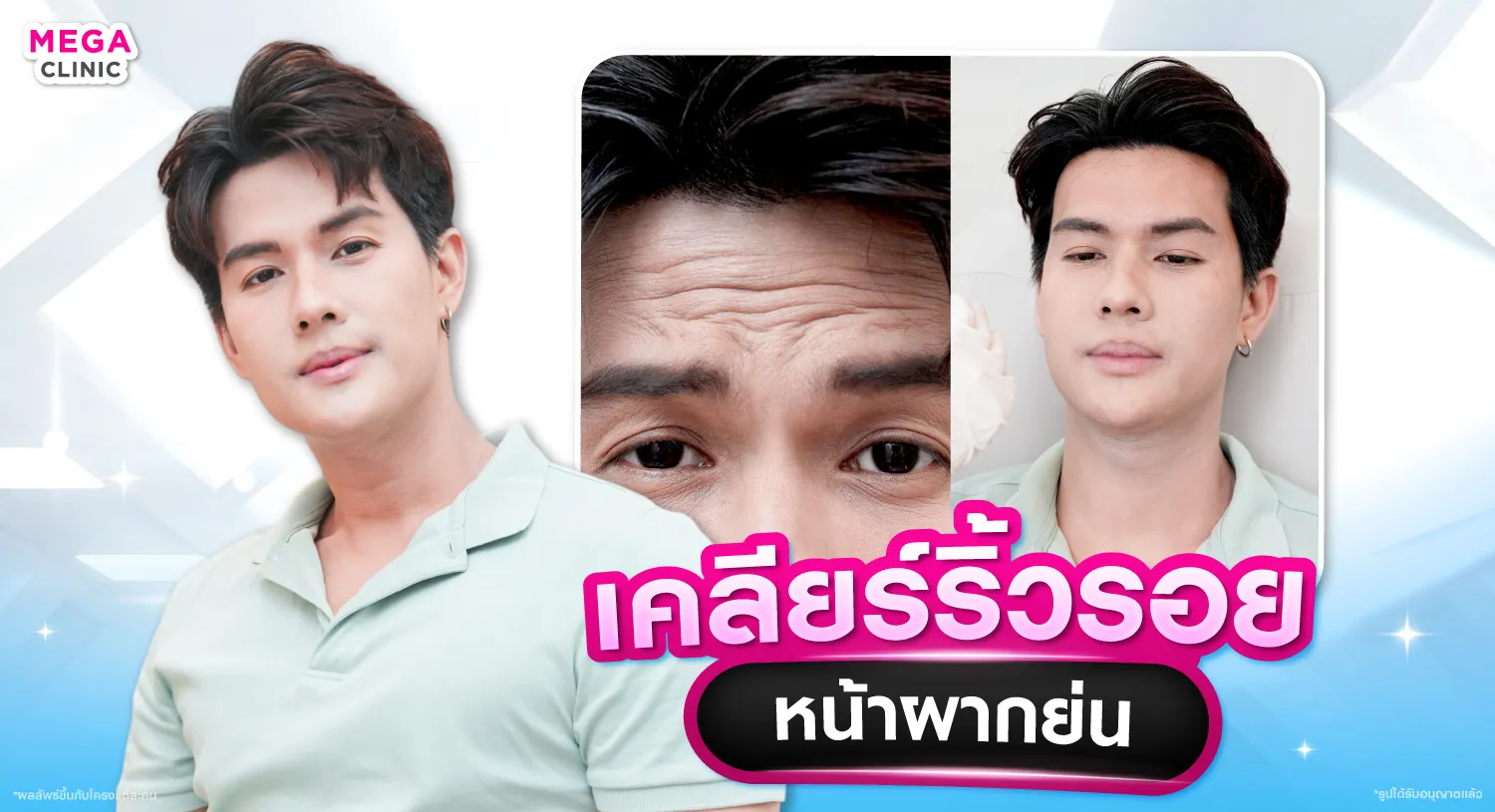 โบท็อกหน้าผาก แก้หน้าผากย่น