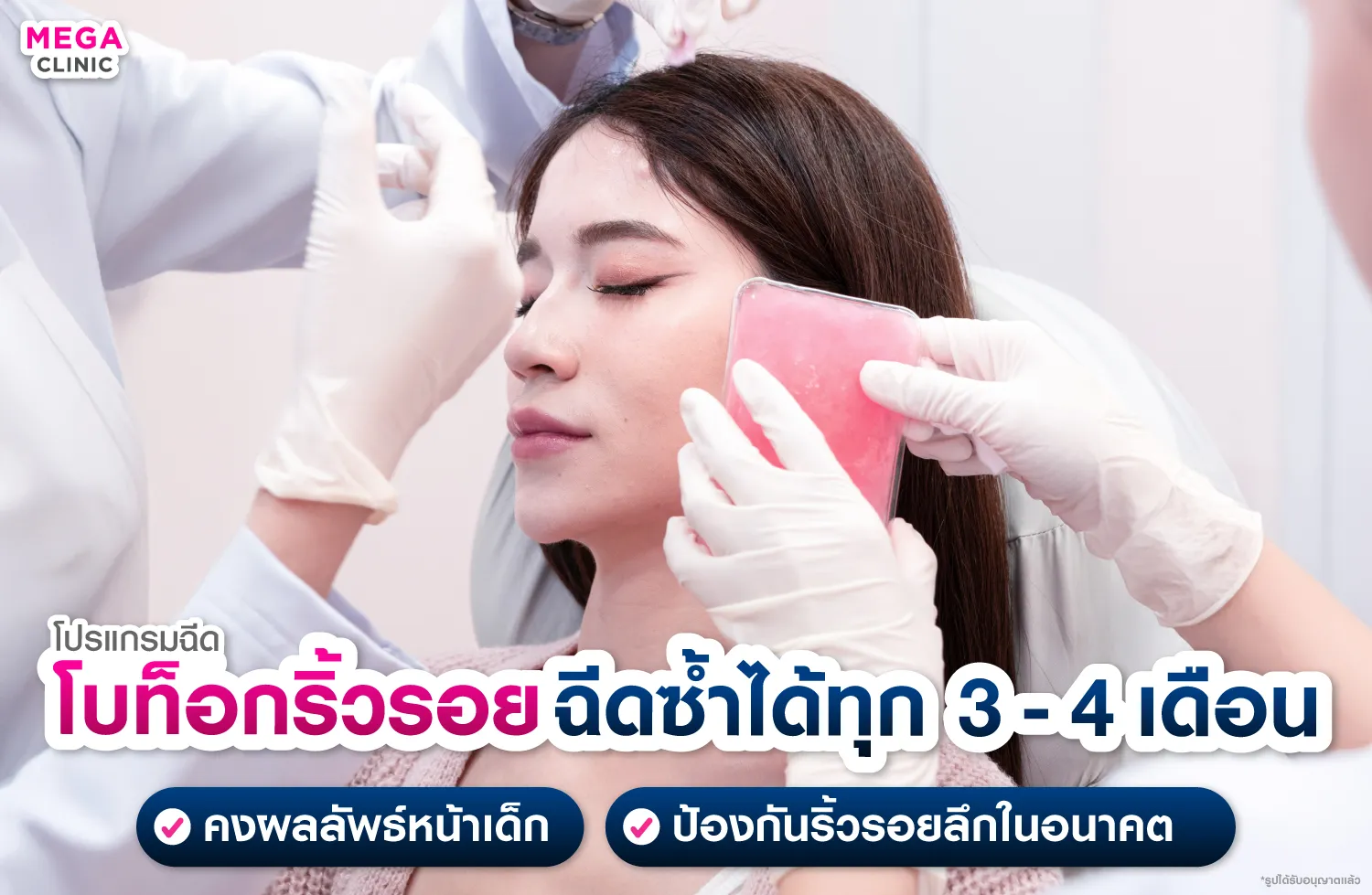 โบท็อกริ้วรอย ฉีดซ้ำได้ทุก 3-4 เดือน