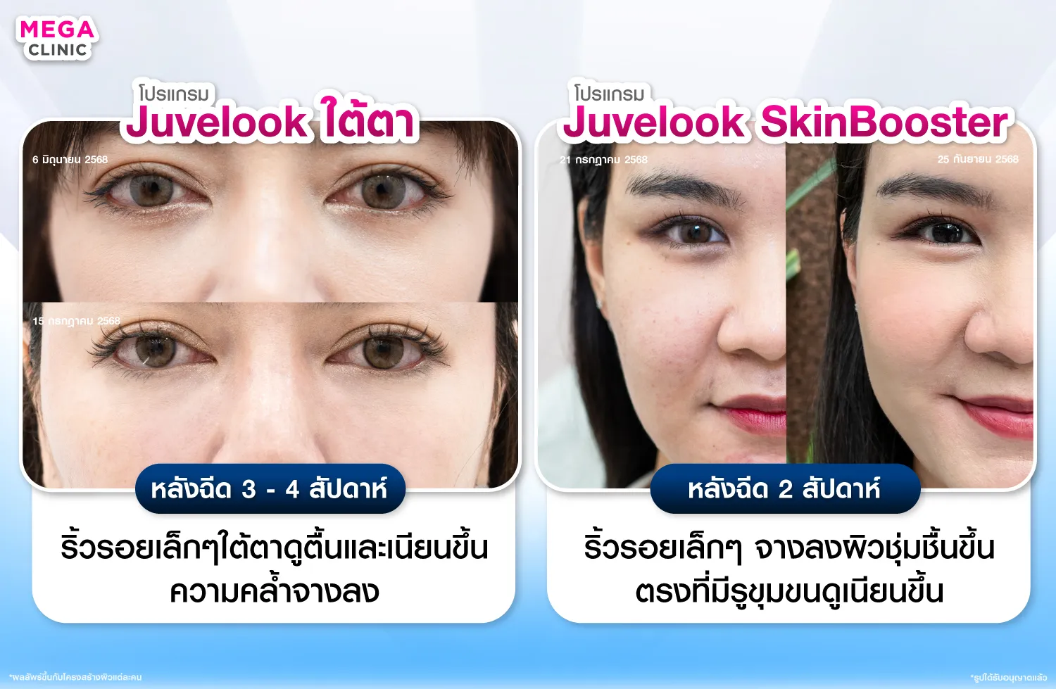 Juvelook ใต้ตา และ แบบ Skin Booster