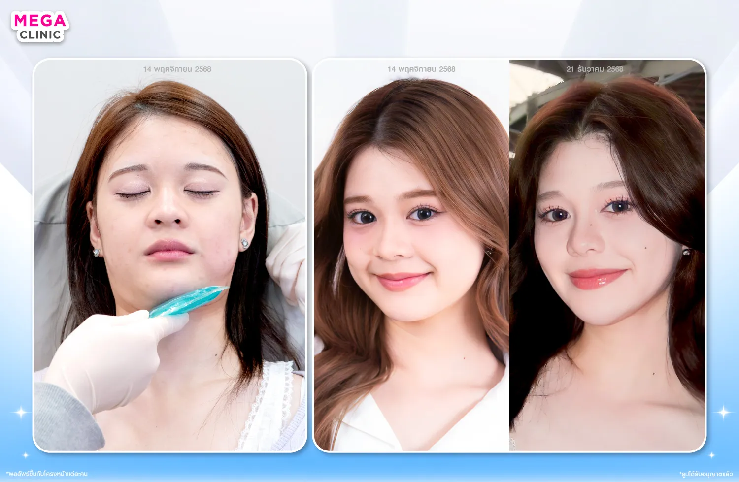 การฉีดแฟตเหนียง