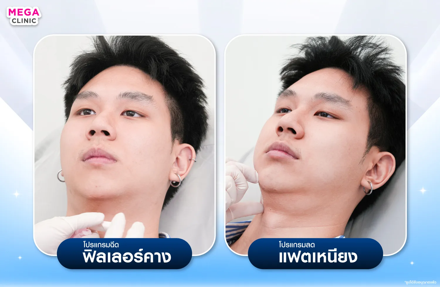 ขณะทำฟิลเลอร์คาง และ ฉีดแฟตเหนียง