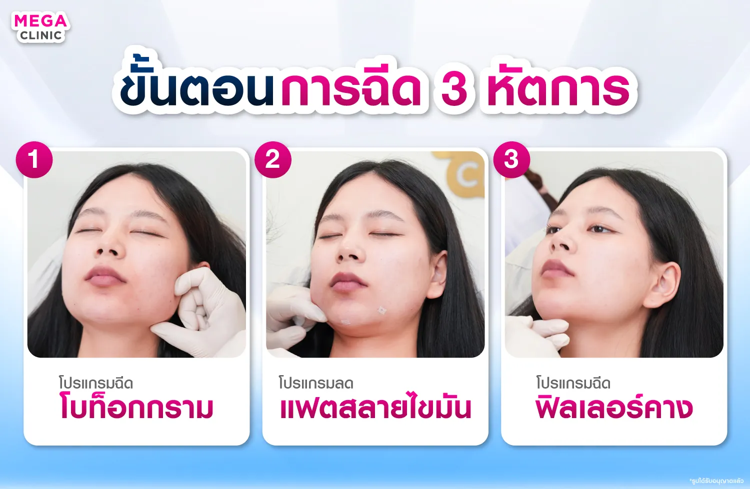ฉีดโบลดกราม ฉีดแฟต และฟิลเลอร์คาง