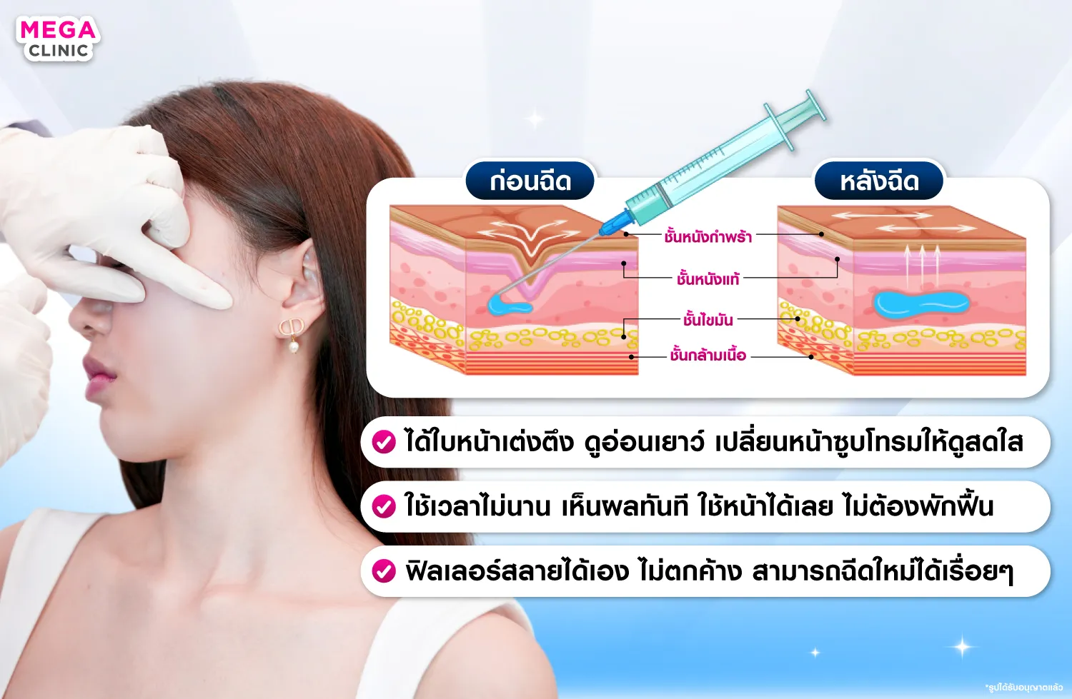 การทำงานของฟิลเลอร์แก้มตอบ
