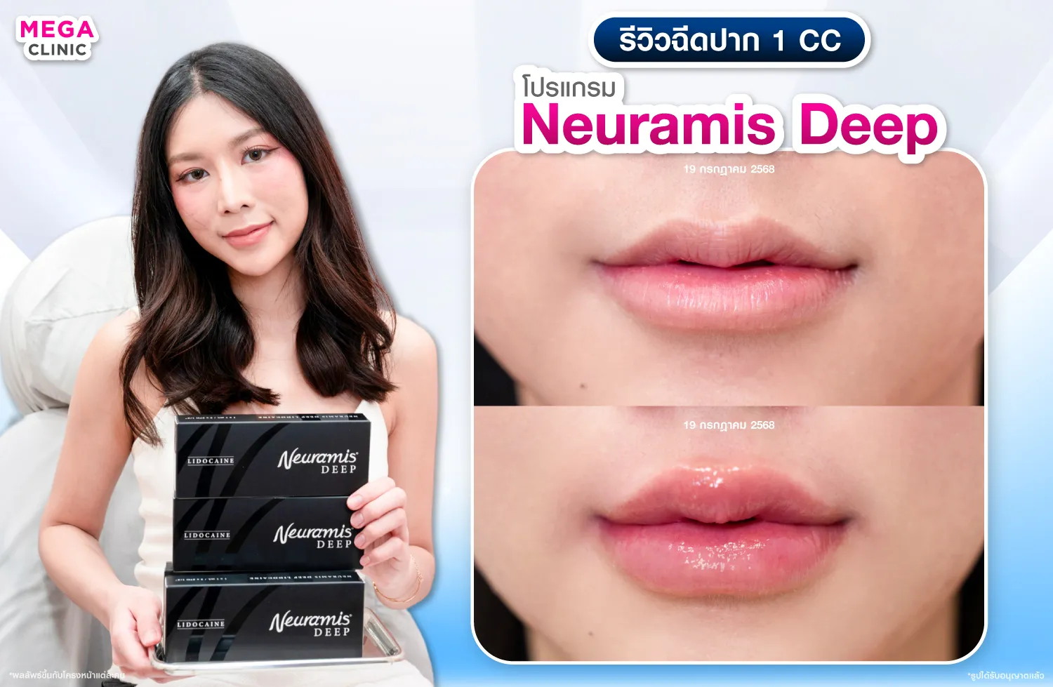 ฟิลเลอร์ปาก Neuramis Deep