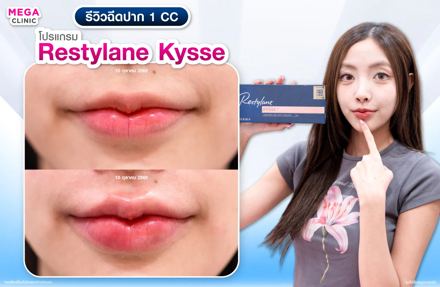 ฟิลเลอร์ปาก Restylane Kysse