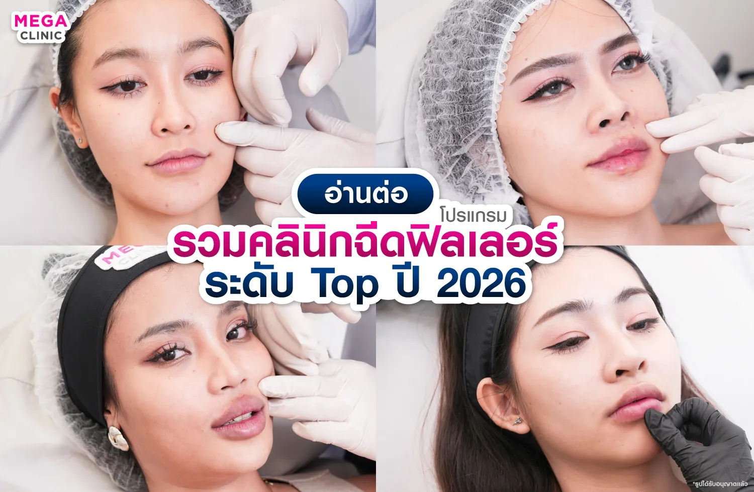 ฉีดฟิลเลอร์ปาก ที่ไหนดี
