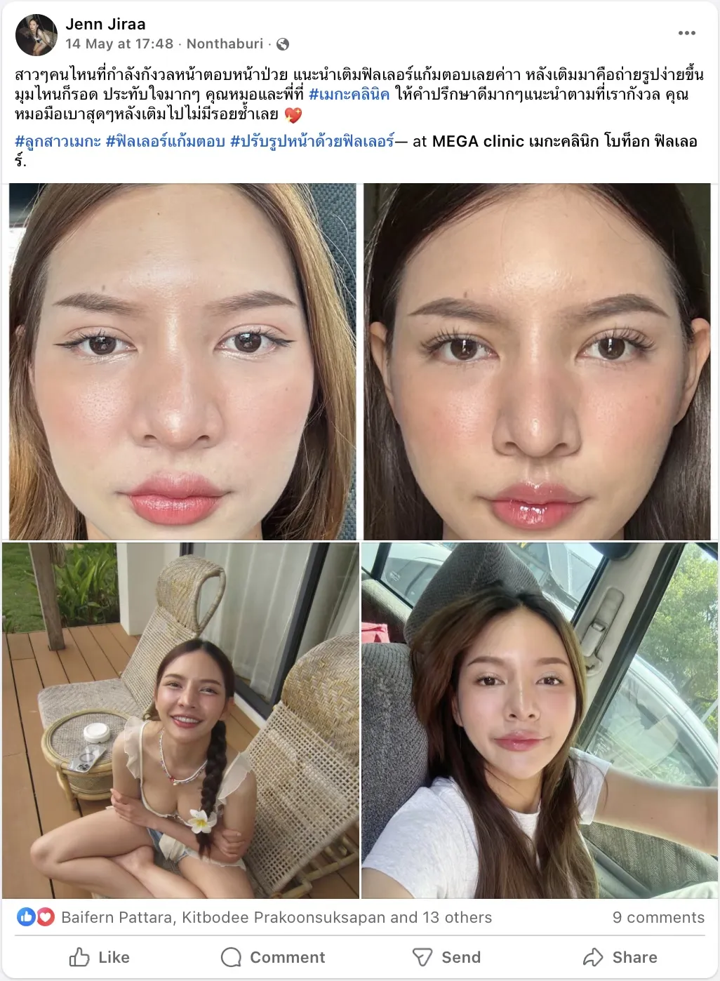 ฟิลเลอร์แก้มตอบรีวิว
