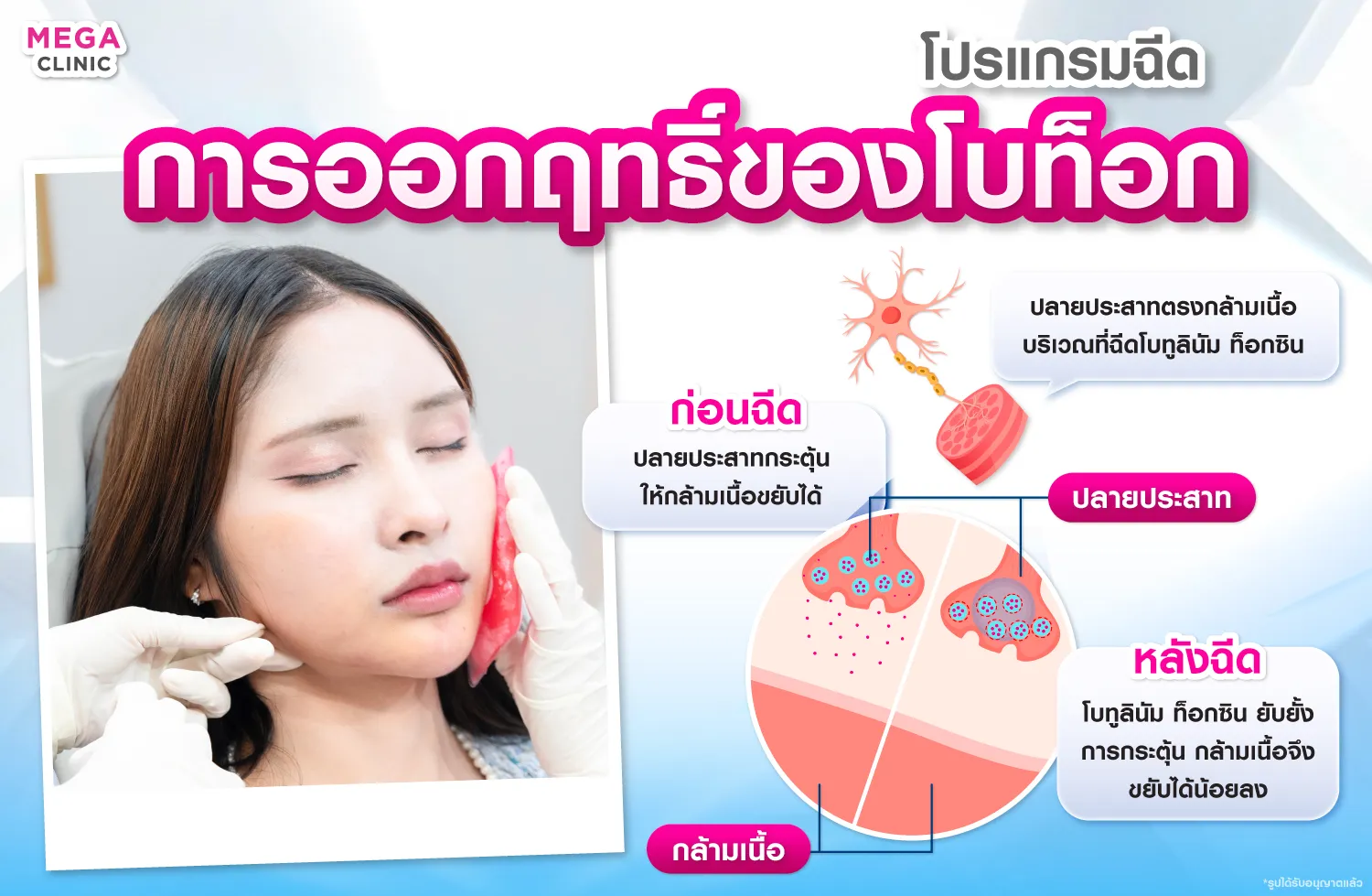 ฉีดโบท็อกกราม คืออะไร