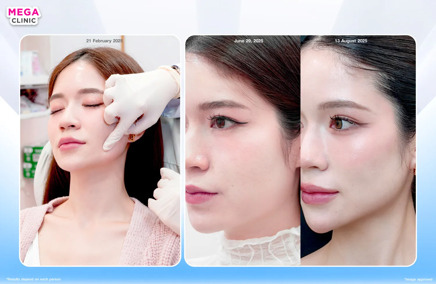 Botox for Face Lifting