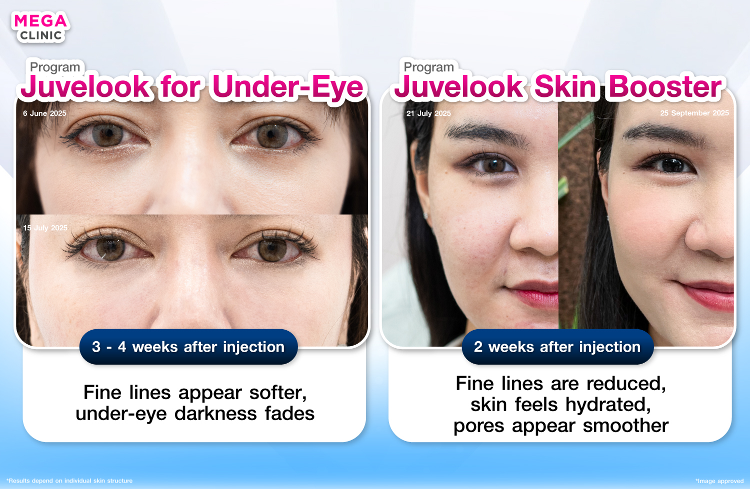 Juvelook ใต้ตา และ แบบ Skin Booster