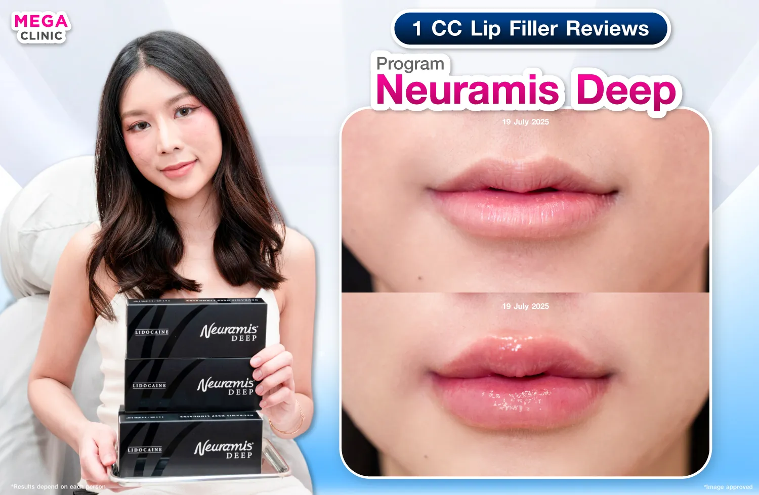 ฟิลเลอร์ปาก Neuramis Deep