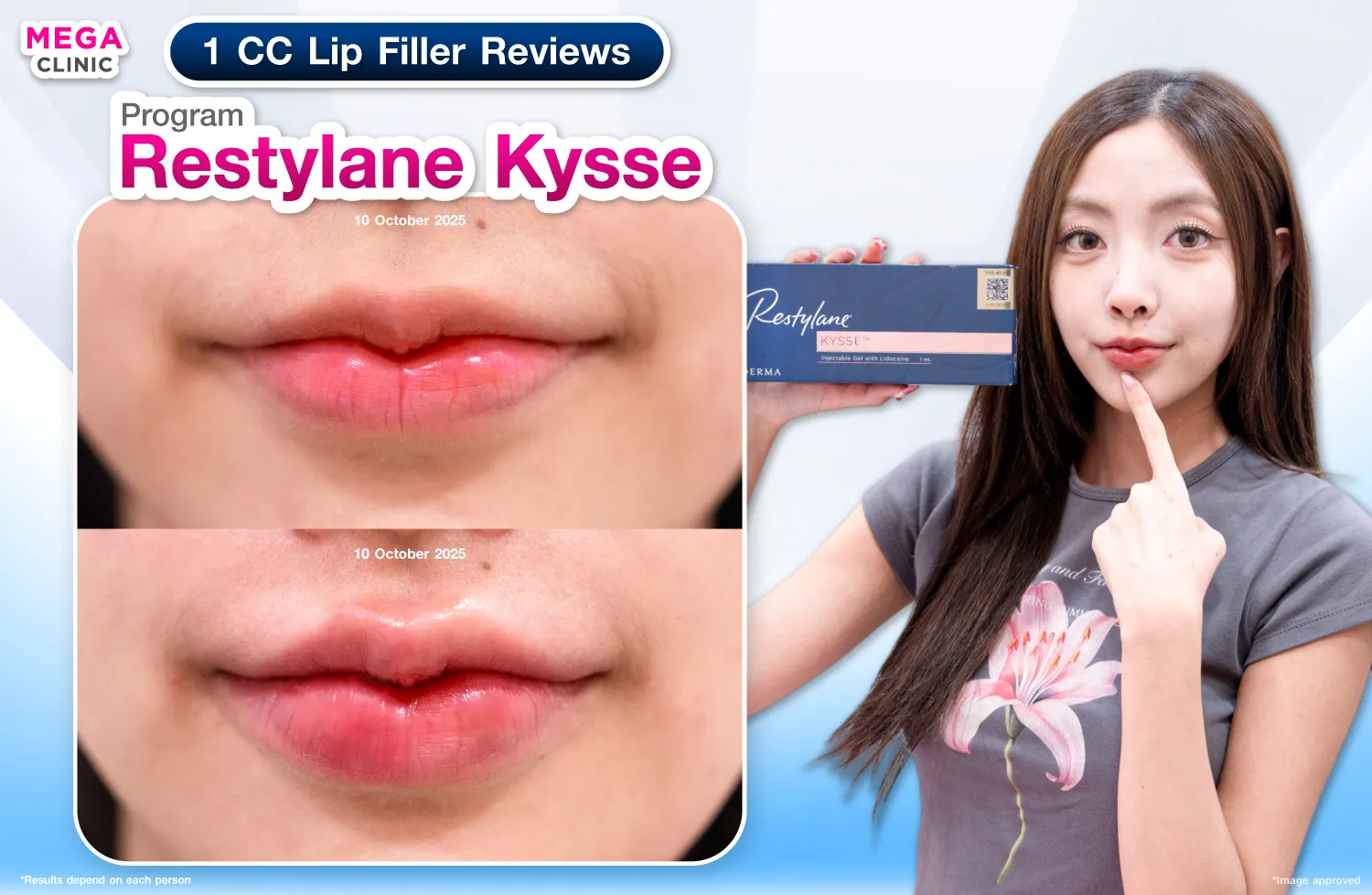 ฟิลเลอร์ปาก Restylane Kysse