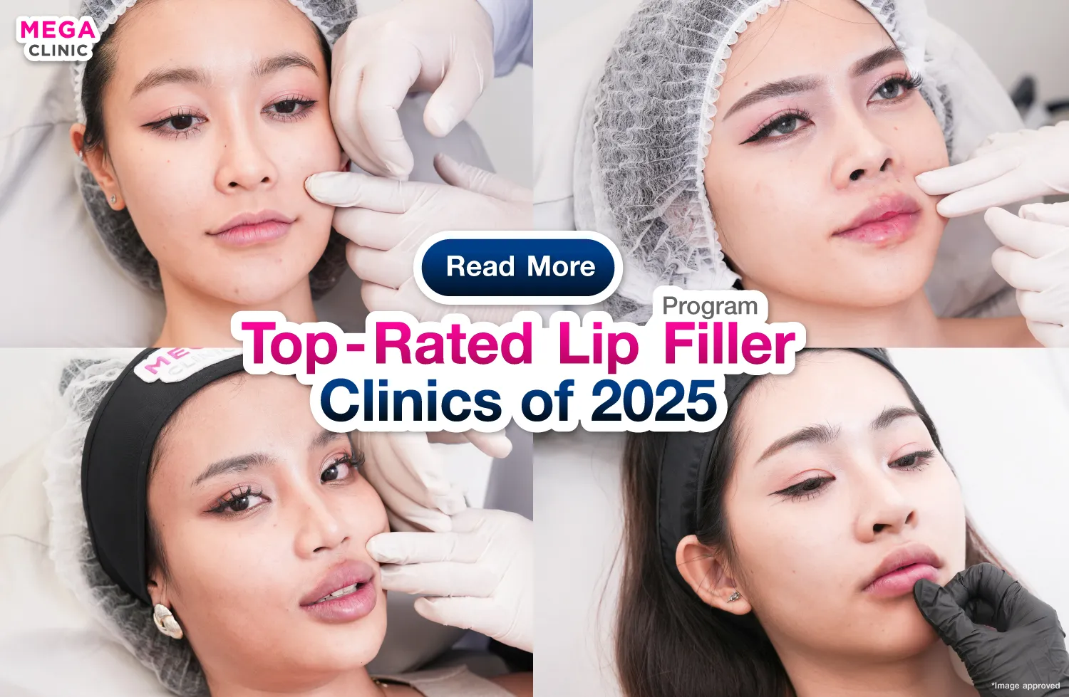 Where to get lip fillers?