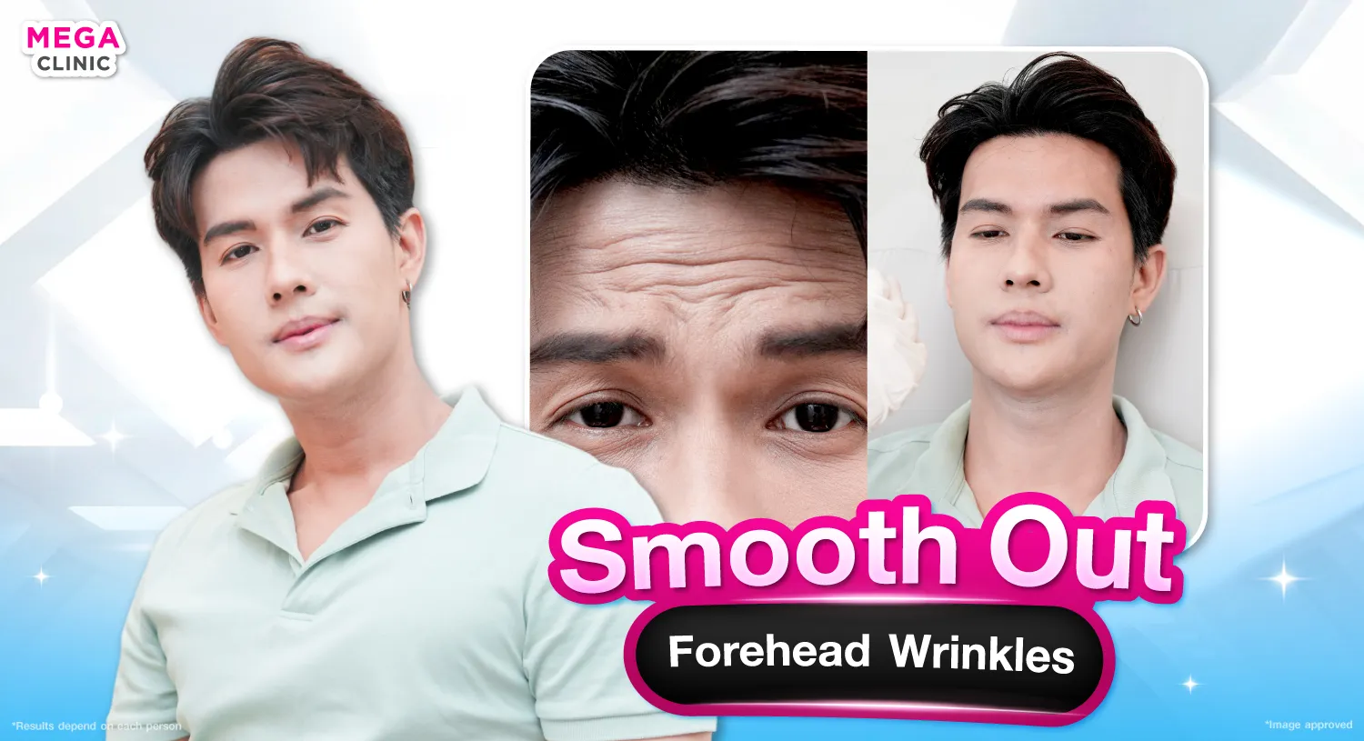 โบท็อกหน้าผาก แก้หน้าผากย่น