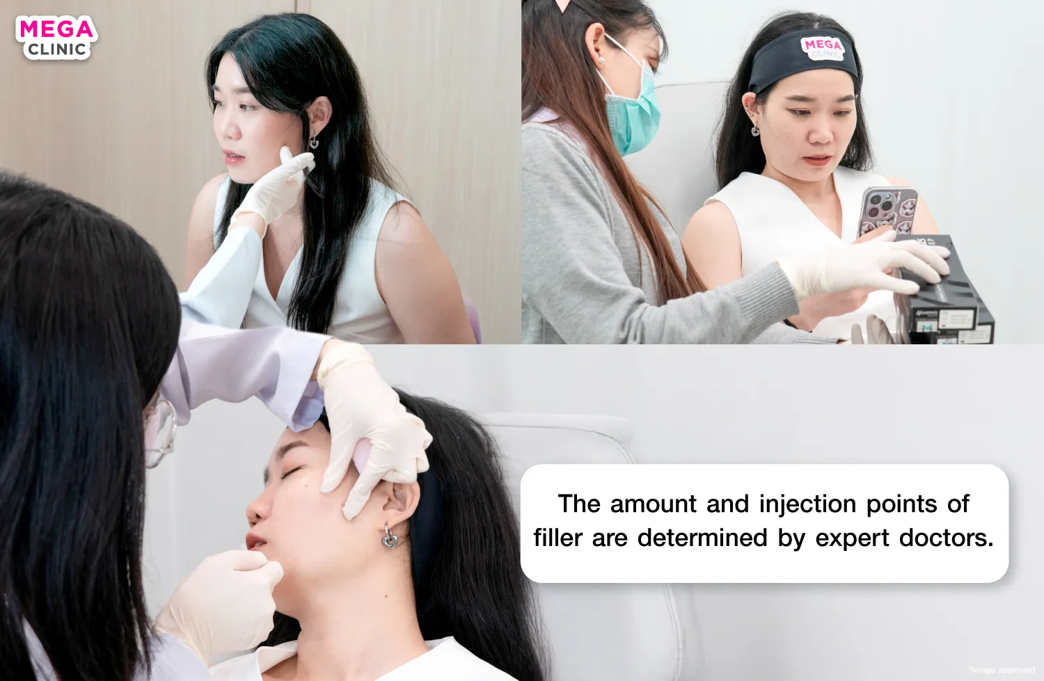 Sunken cheek fillers