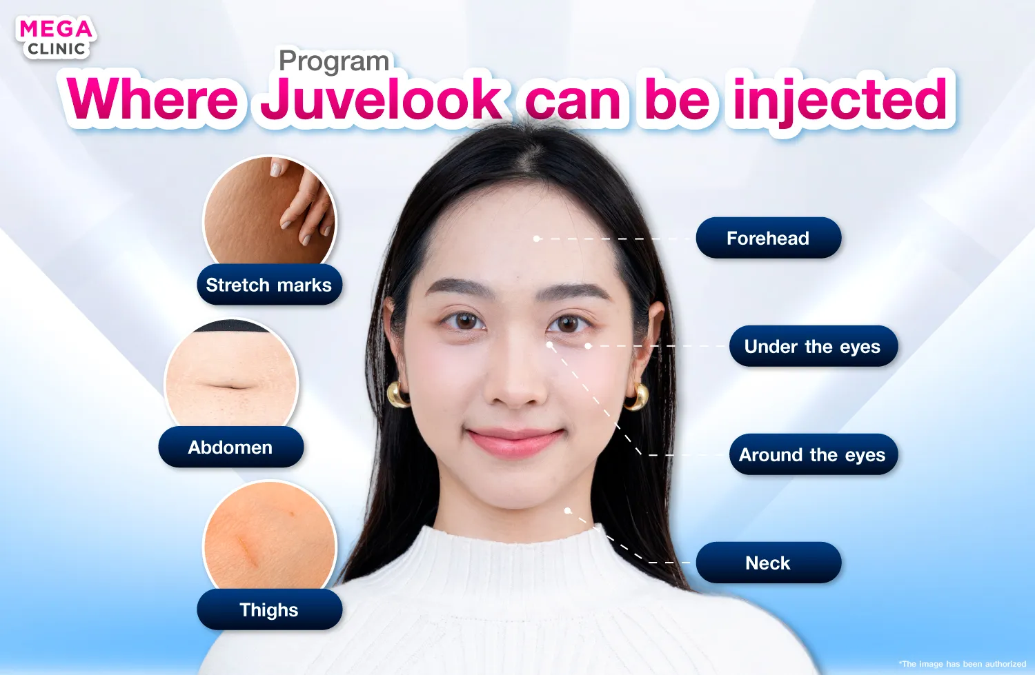 Juvelook ฉีดตรงไหน