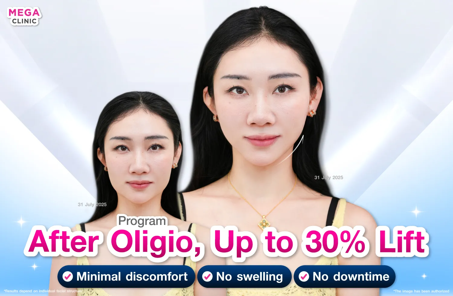 oligio ยกกระชับผิวหย่อนคล้อย