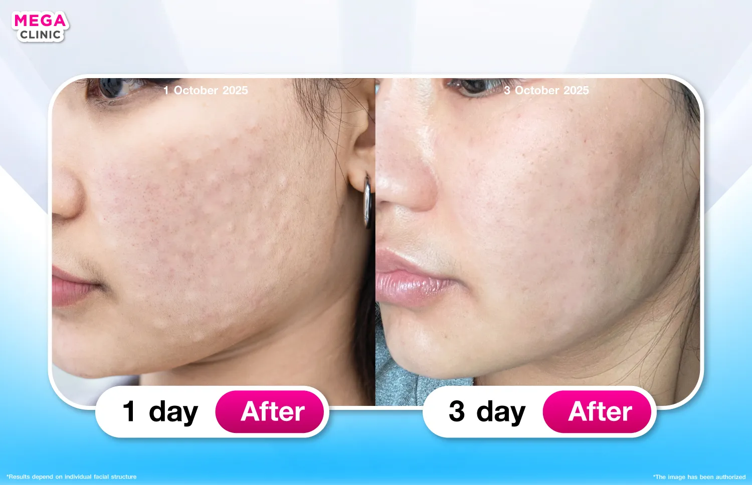 รีวิว Rejuran
