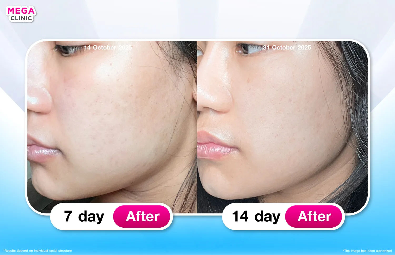 รีวิว Rejuran
