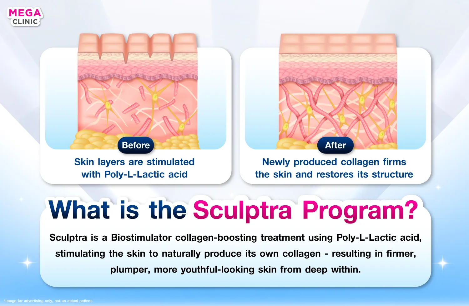 sculptra คืออะไร ช่วยอะไร