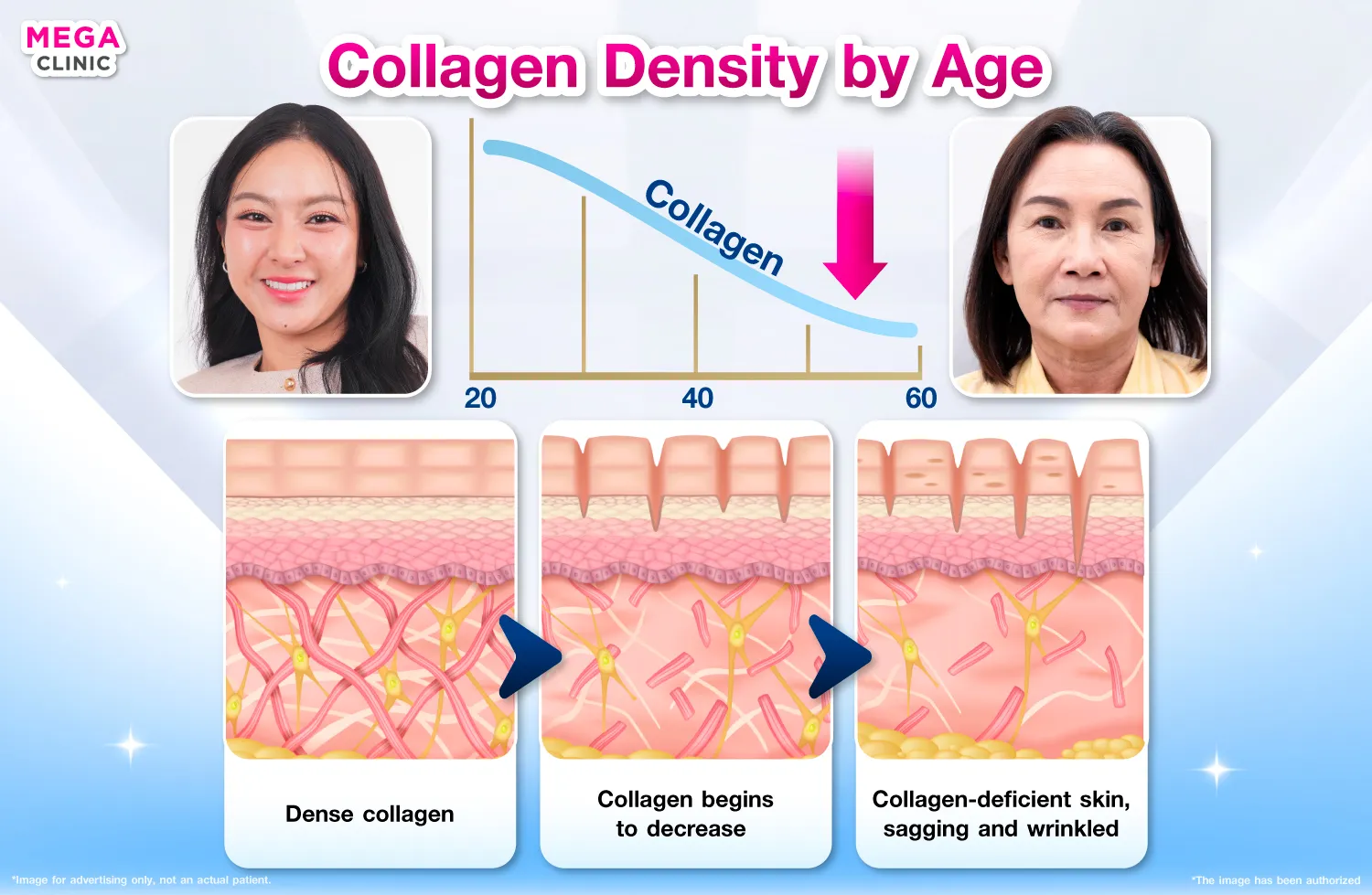 sculptra กระตุ้นสร้างคอลลาเจน