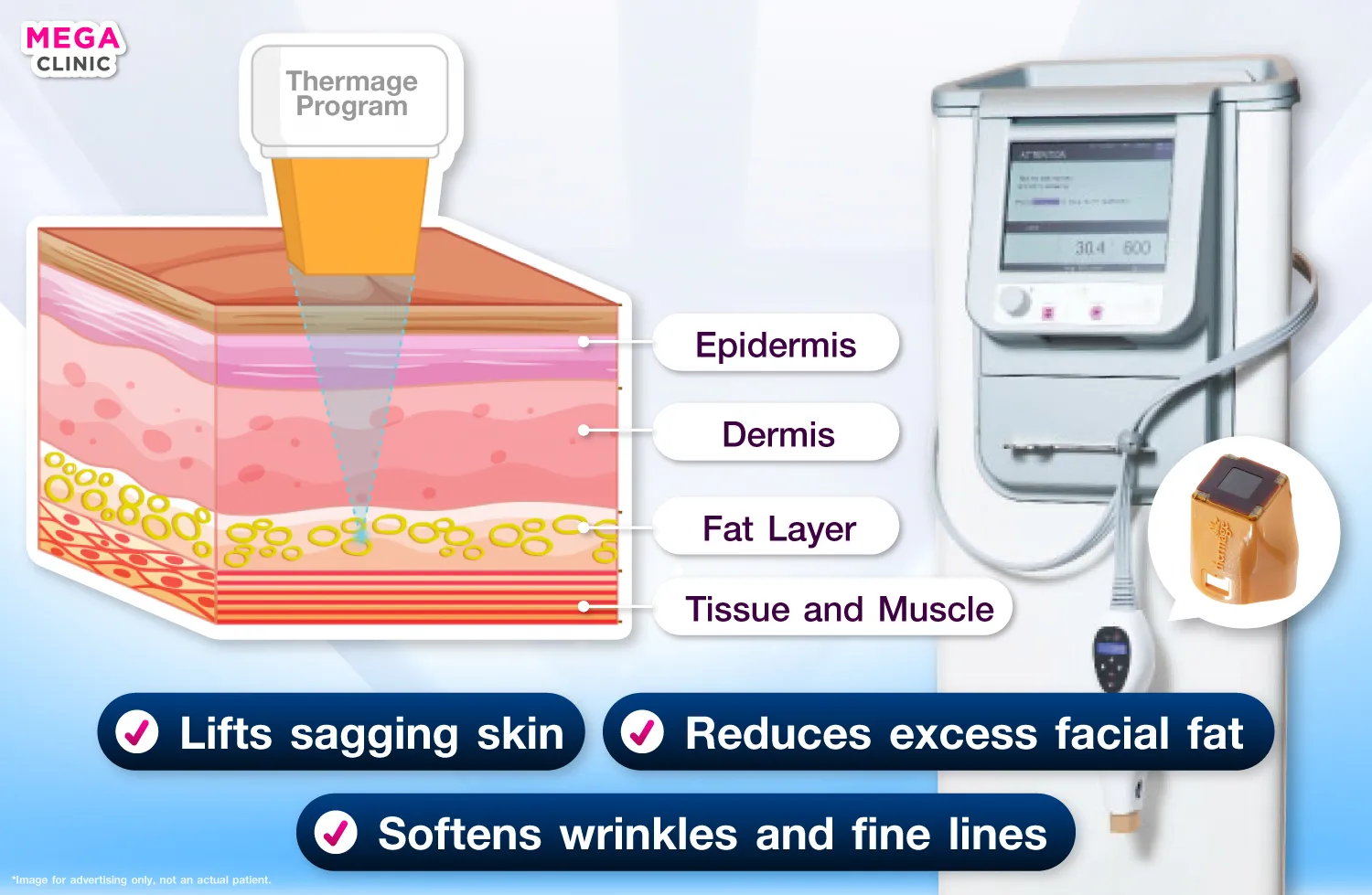 เครื่องยกกระชับ thermage ทำงานอย่างไร ในการช่วยยกกระชับผิวหย่อน ลดไขมันสะสม และ ลดริ้วรอยเหี่ยวย่น