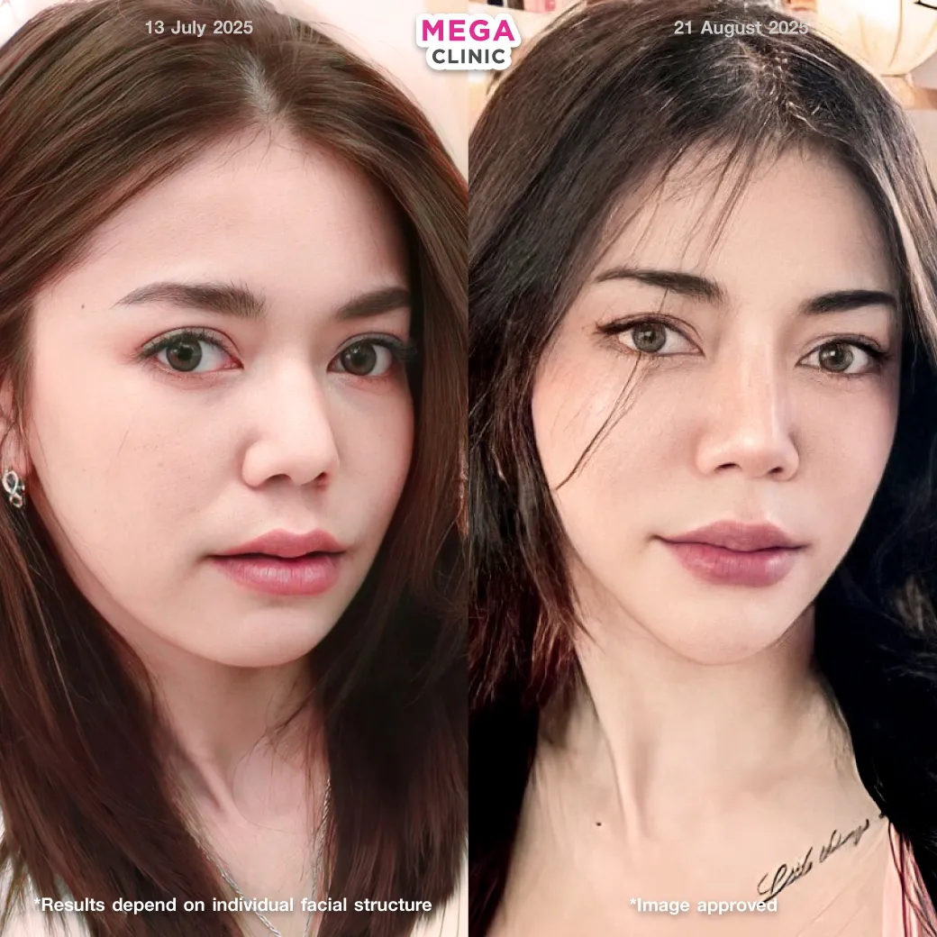 thermage รีวิวก่อนและหลังยกกระชับ