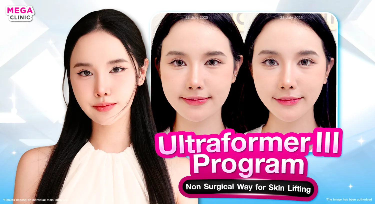 What is Ultraformer III?