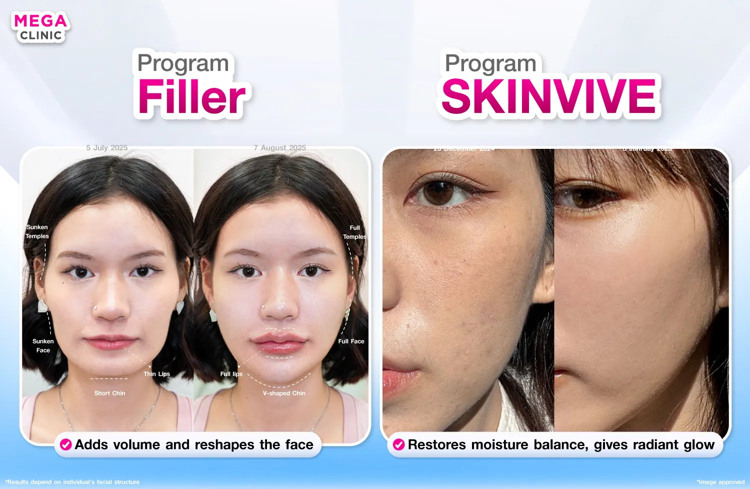 Skinvive ต่างจาก ฟิลเลอร์ยังไง