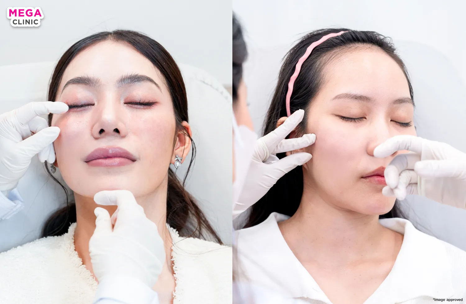 Skinvive ฉีดตรงไหน?