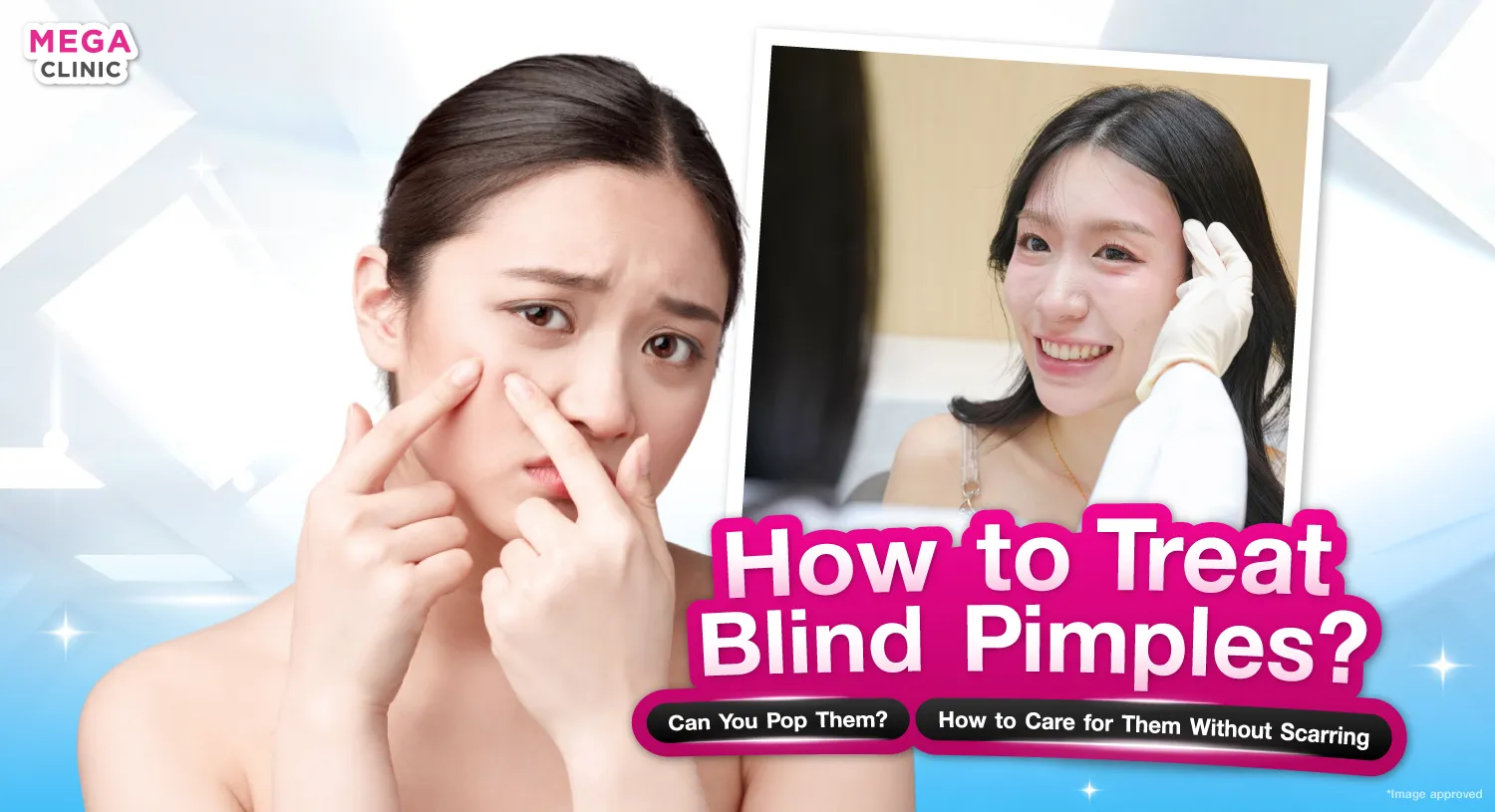 สิวไม่มีหัว นูน ๆ รักษายังไง