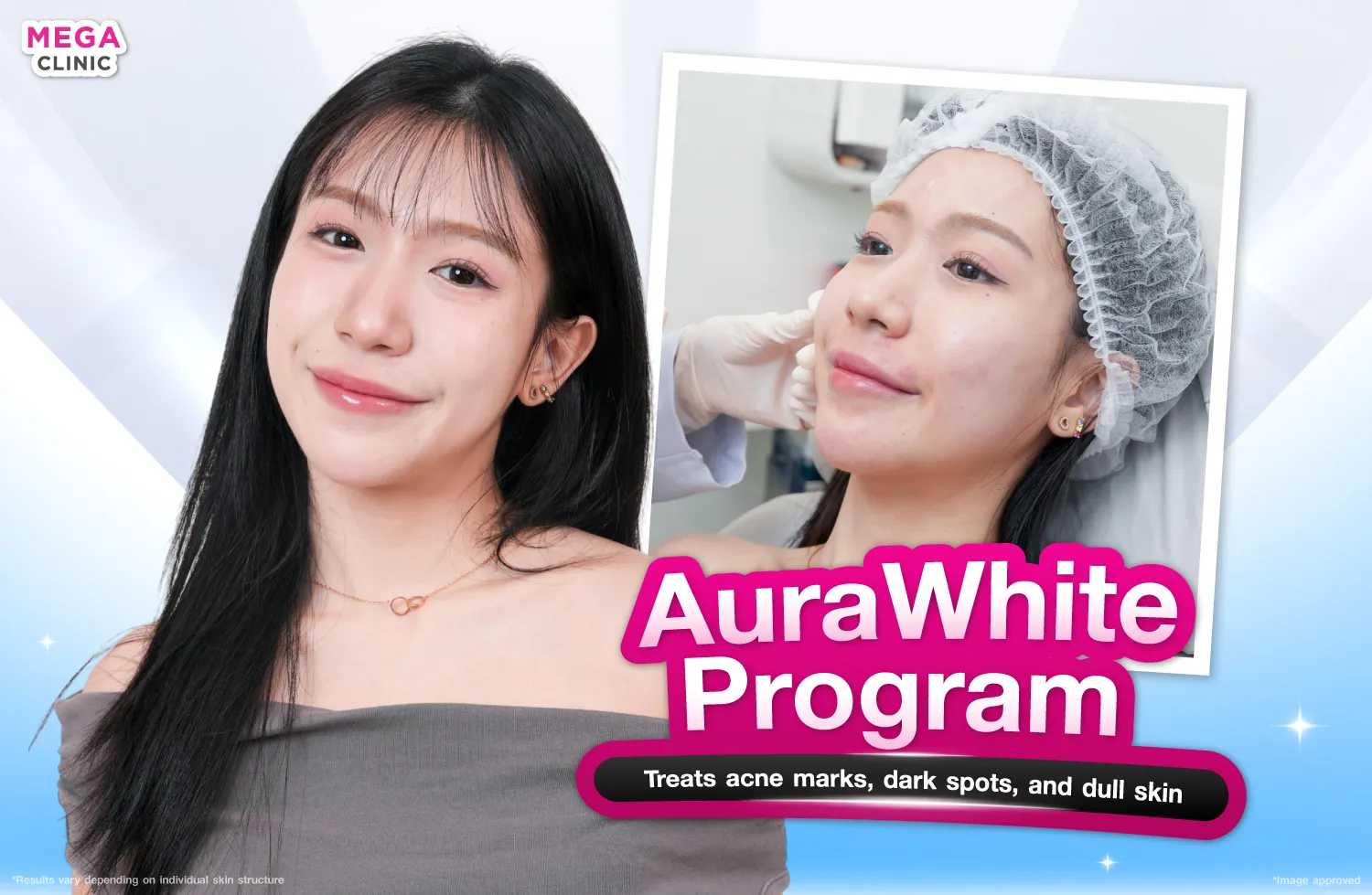 ฉีดAuraWhite เหมาะกับรอยสิว รอยดำ และผิวหมองหลังสิว