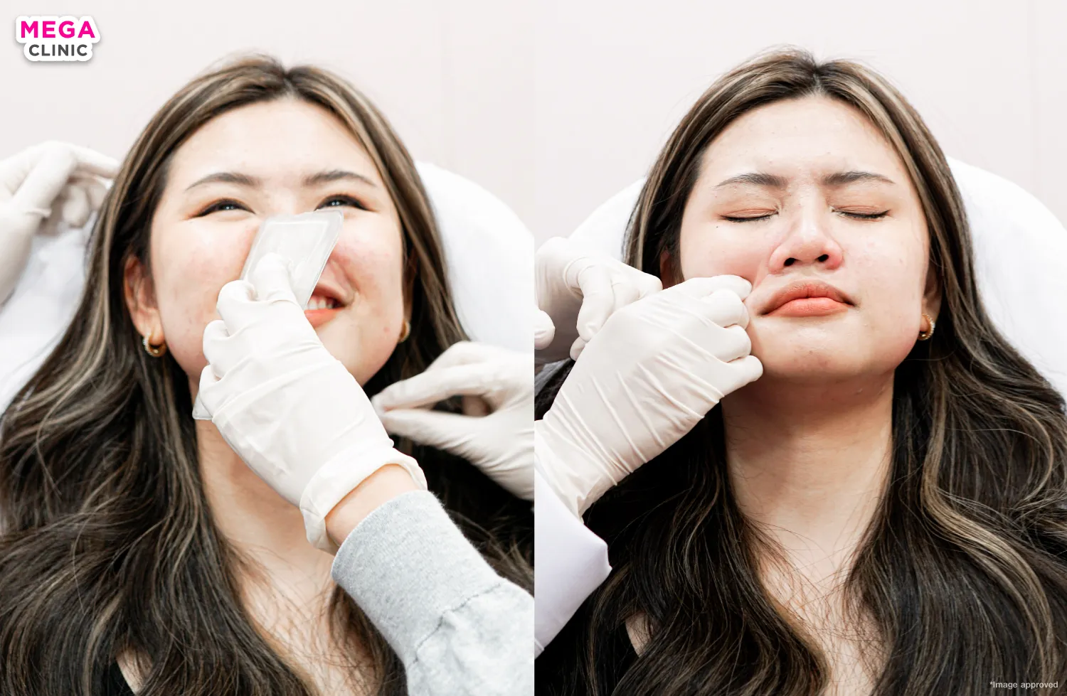 ฉีดโบท็อกปีกจมูก