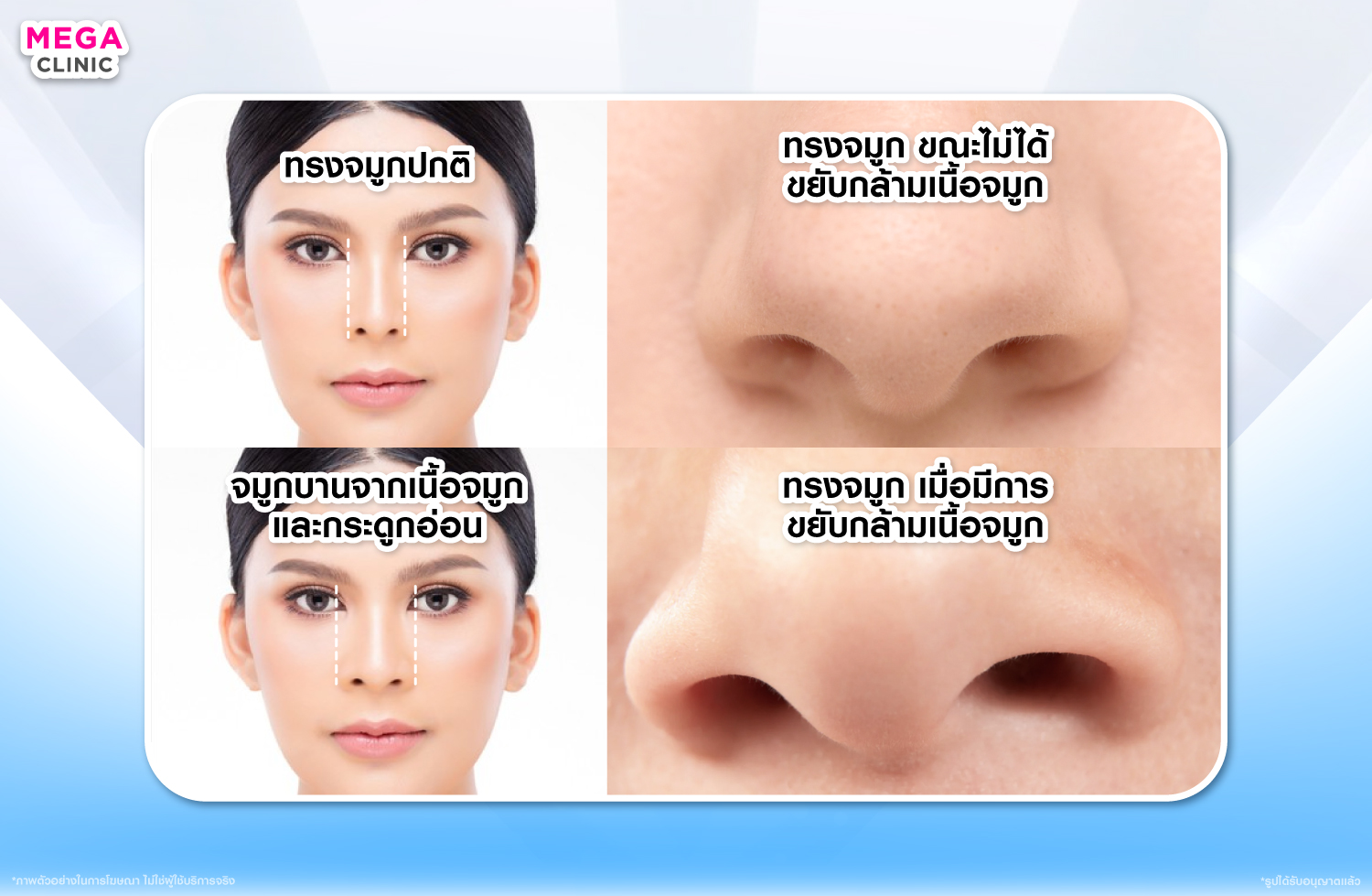 จมูกบานเกิดจากอะไร