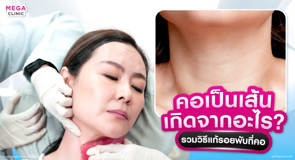 คอเป็นเส้น เกิดจากอะไร