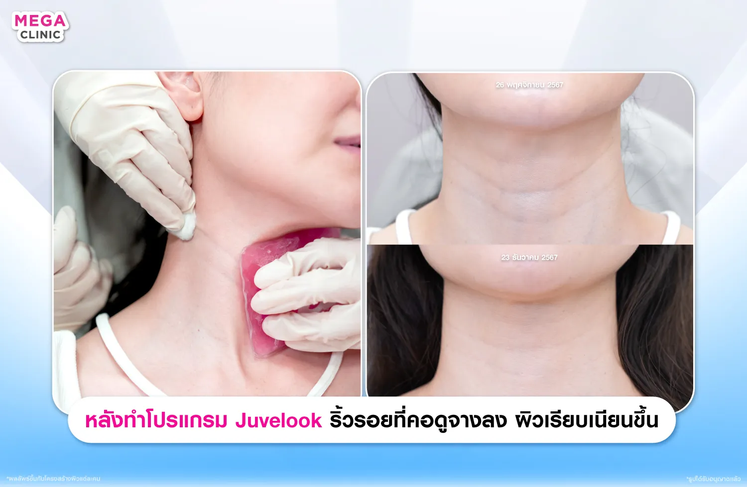 Juvelook เติมเต็มริ้วรอ
