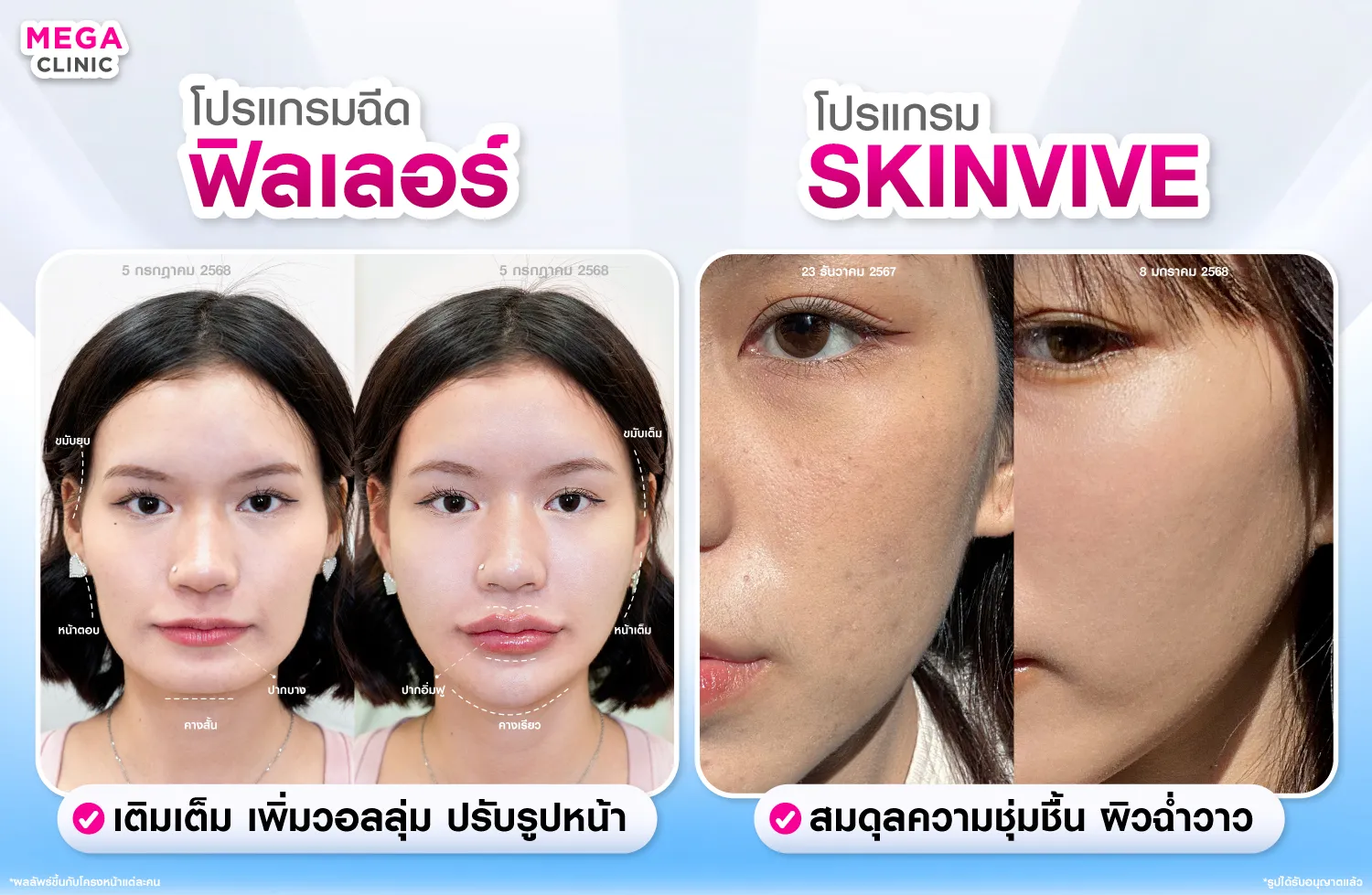 Skinvive ต่างจาก ฟิลเลอร์ยังไง