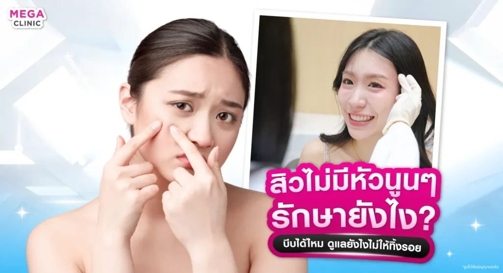 สิวไม่มีหัว นูน ๆ รักษายังไง