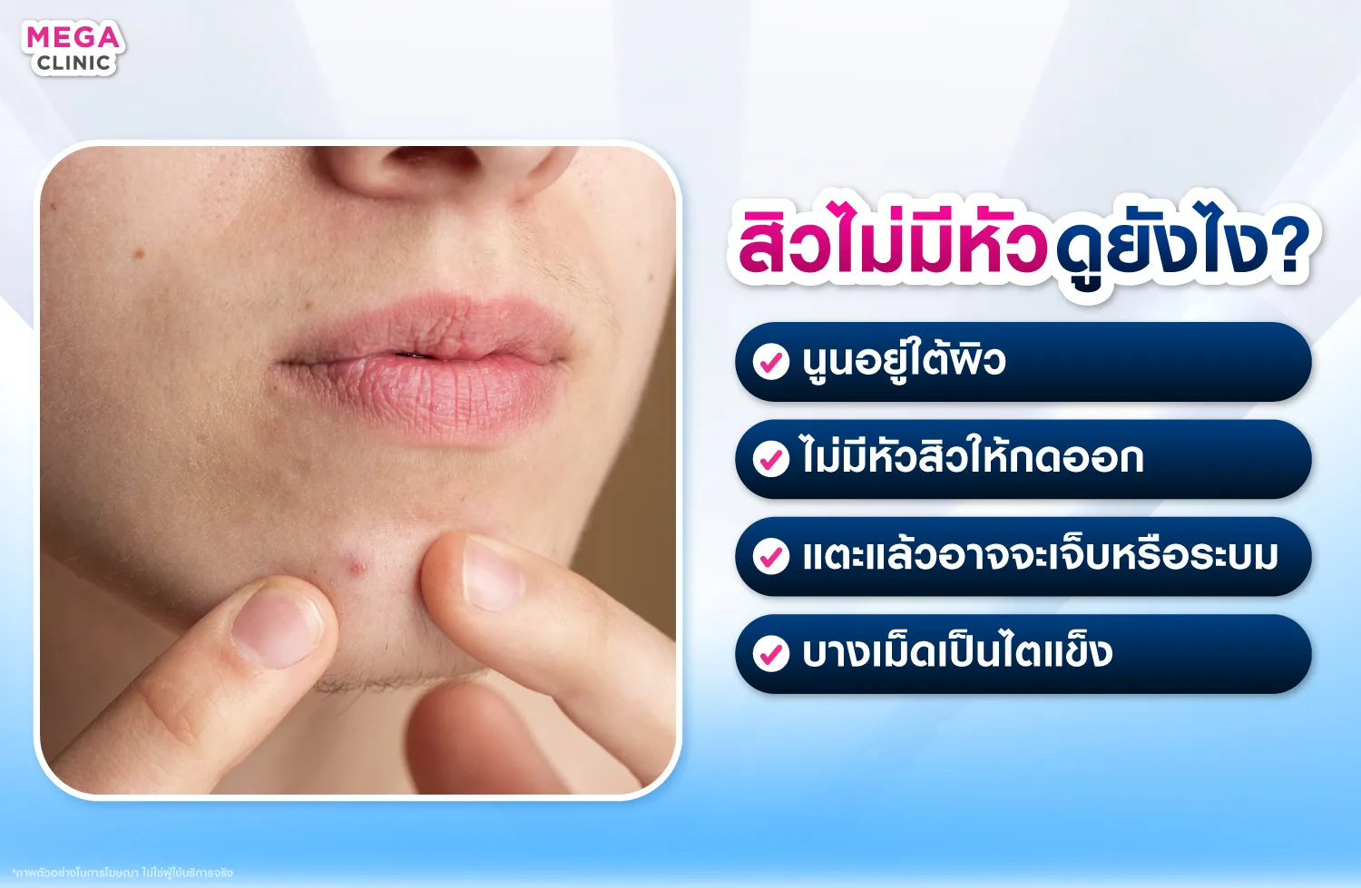 สิวไม่มีหัวคืออะไร