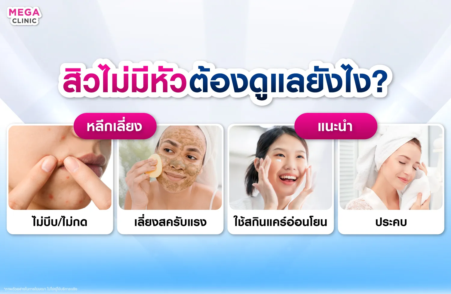 สิวไม่มีหัวรักษายังไง?