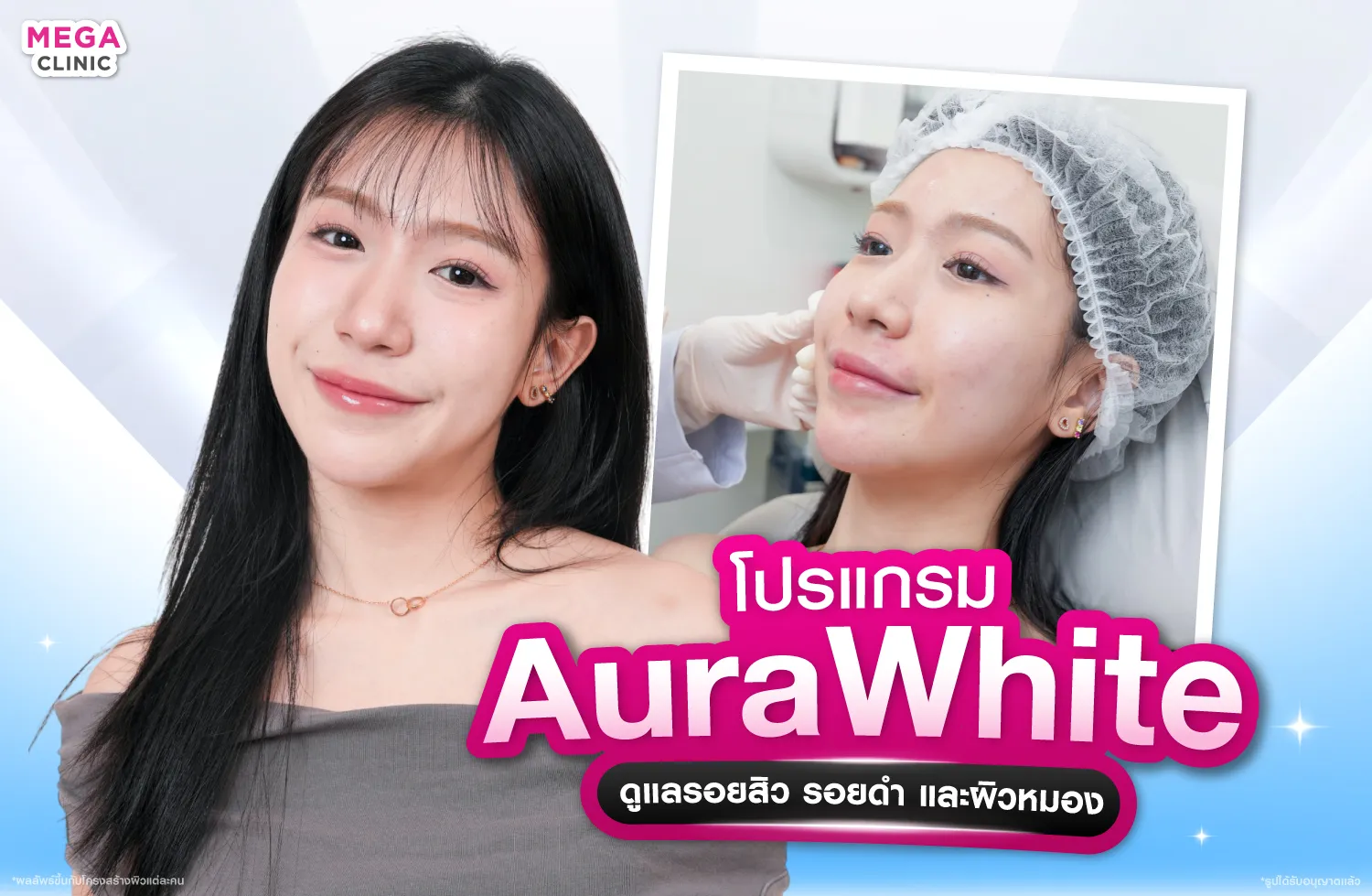 ฉีดAuraWhite เหมาะกับรอยสิว รอยดำ และผิวหมองหลังสิว