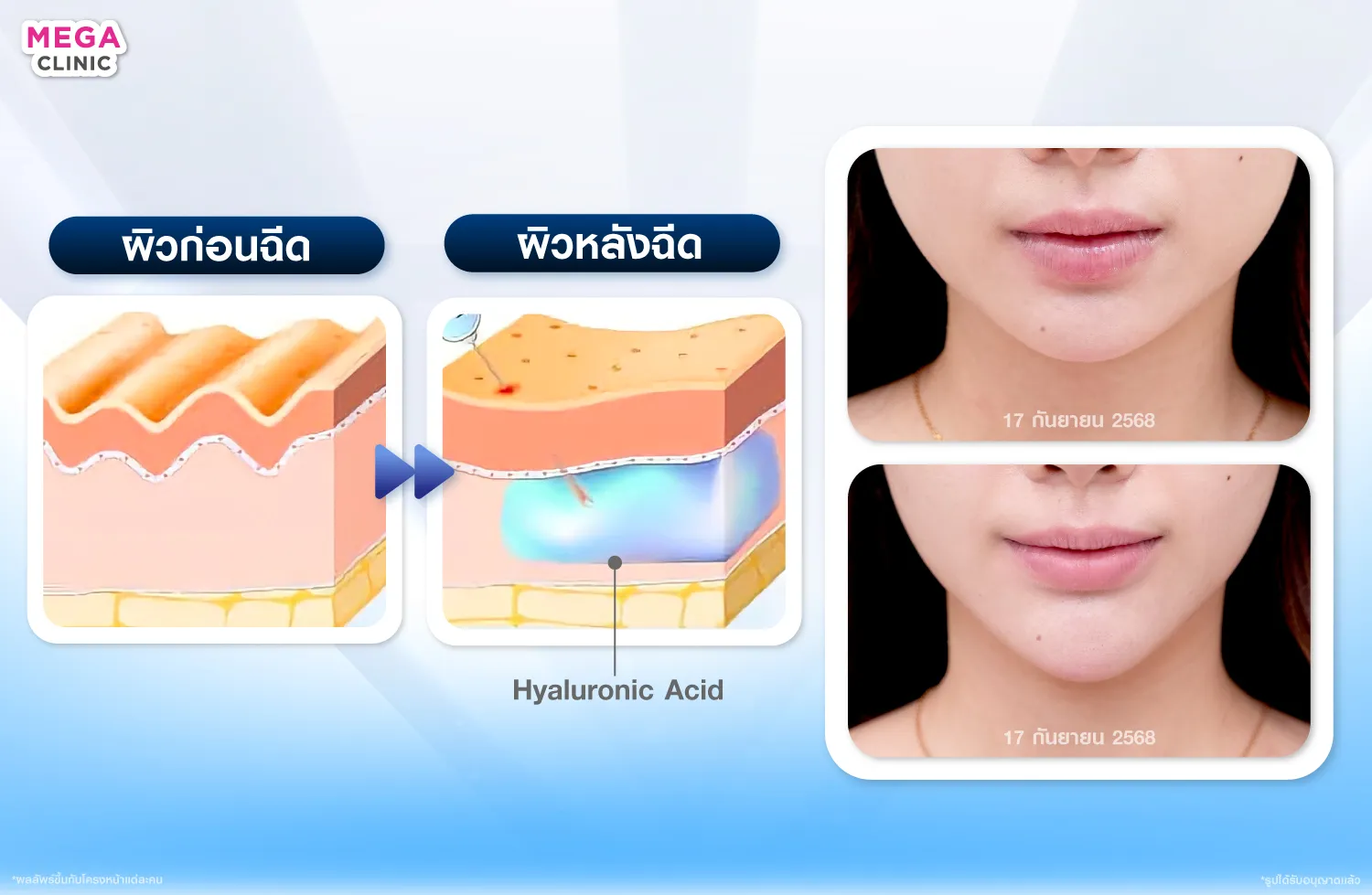 Hyaluronic Acid ในการฉีดฟิลเลอร์คางทำงานยังไง