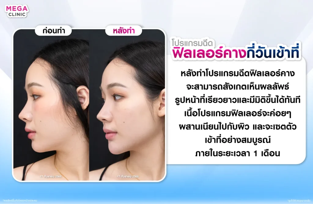 ฉีดฟิลเลอร์คางกี่วันเข้าที่