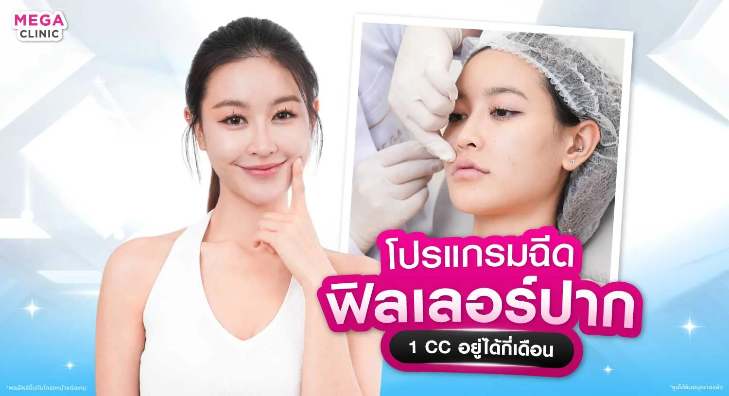 ฟิลเลอร์ปาก 1cc อยู่ได้กี่เดือน