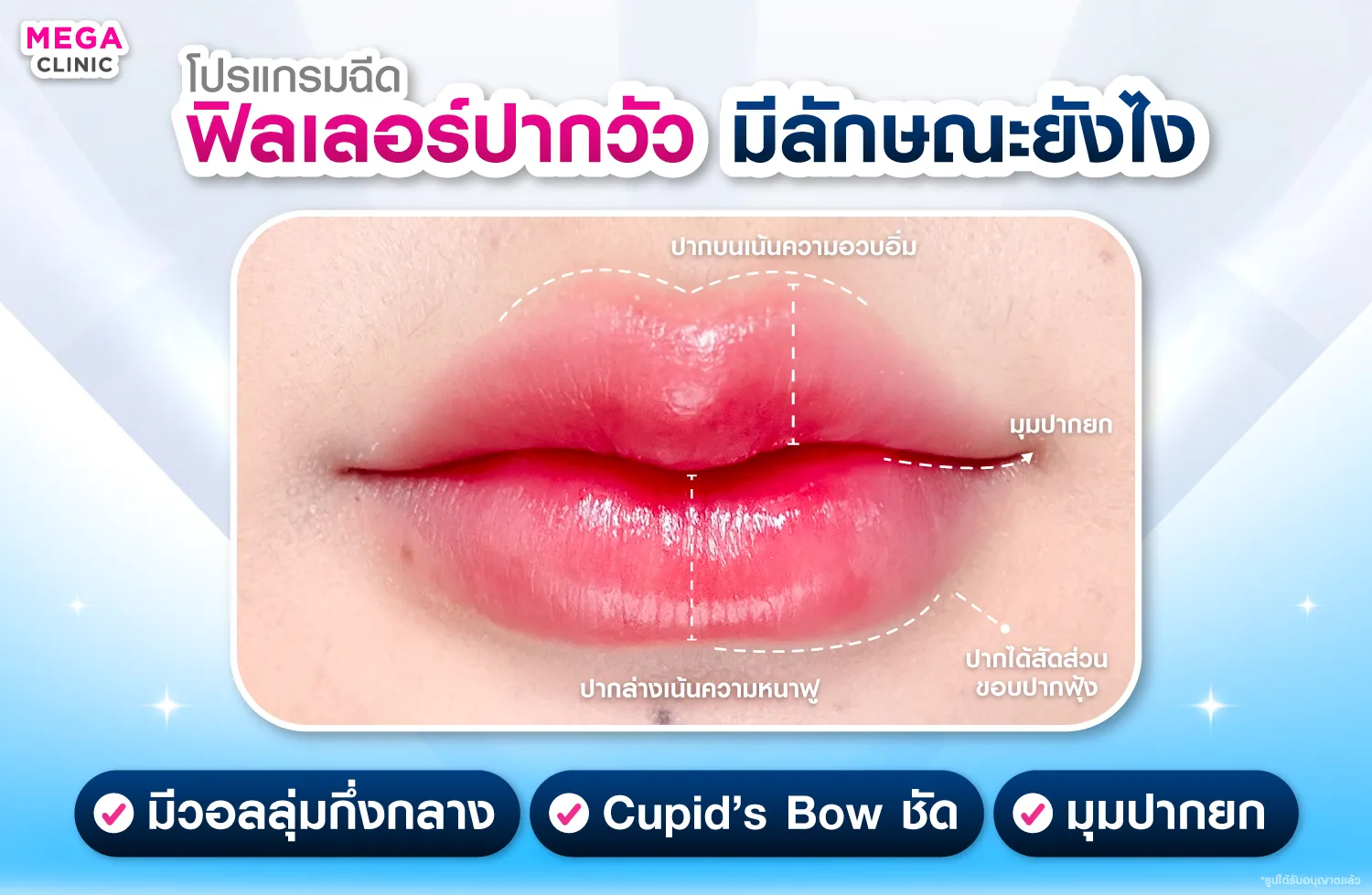 ฟิลเลอร์ปากวัว มีลักษณะอย่างไร ?