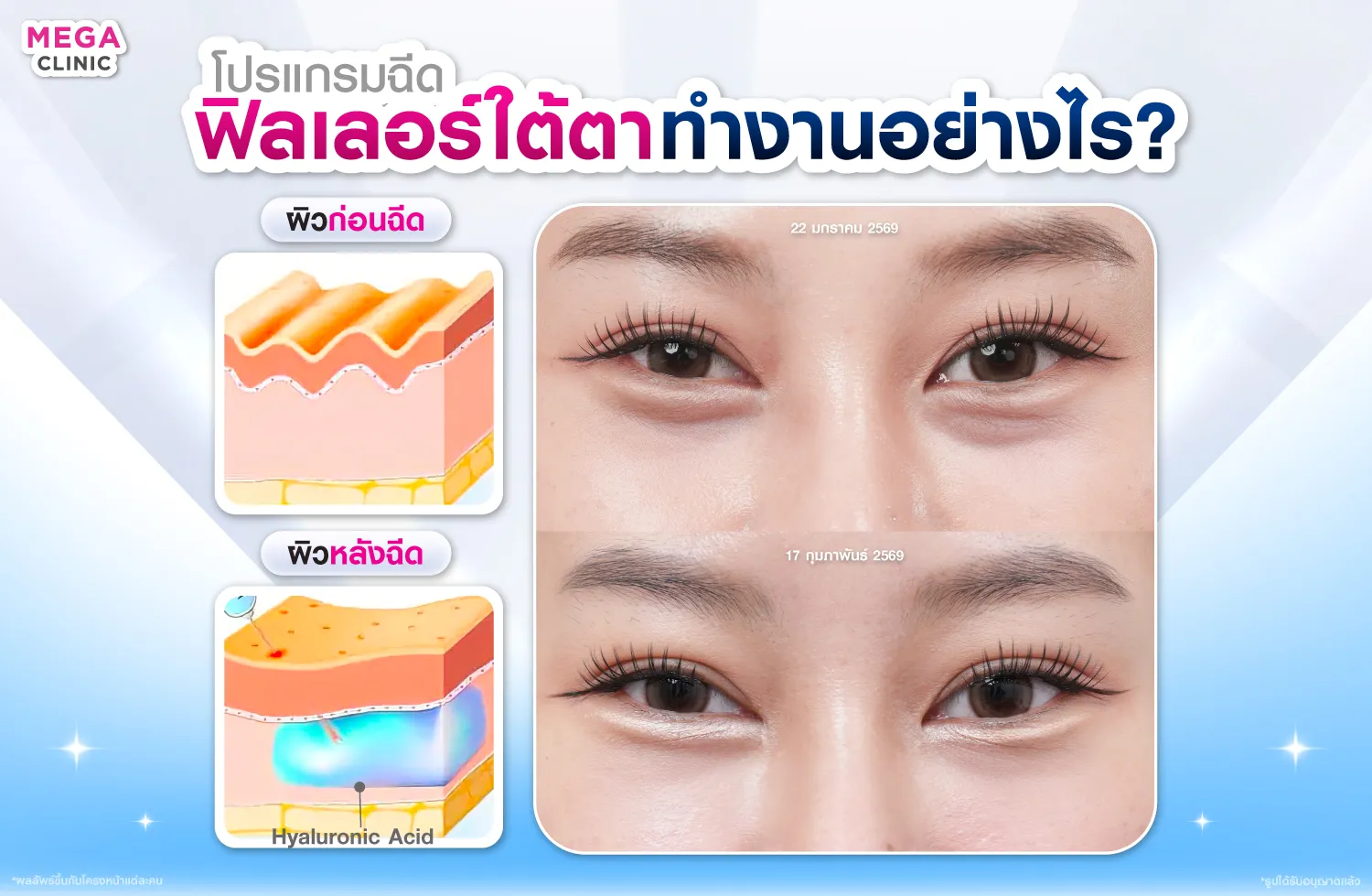 ฟิลเลอร์ใต้ตาทำงานอย่างไร?